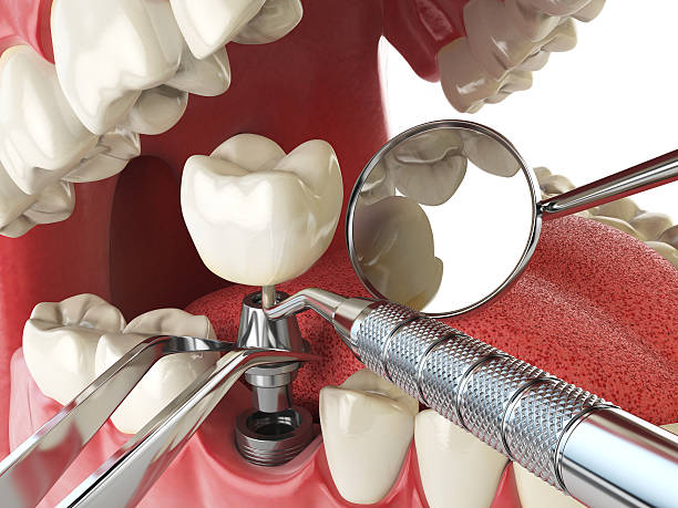 Best Emergency Dentist for Lost Fillings or Crowns in Innsbrook, VA